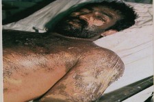 جنایتی به نام بمباران شیمیایی سردشت/تصاویر