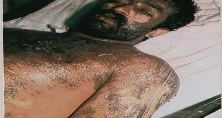 جنایتی به نام بمباران شیمیایی سردشت/تصاویر