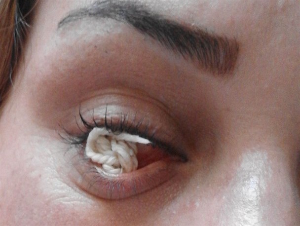 حادثه حیرت انگیز در قوه بینایی بانوی اصلاندوزی/چشمی که نخ تولید می کند+عکس و فیلم